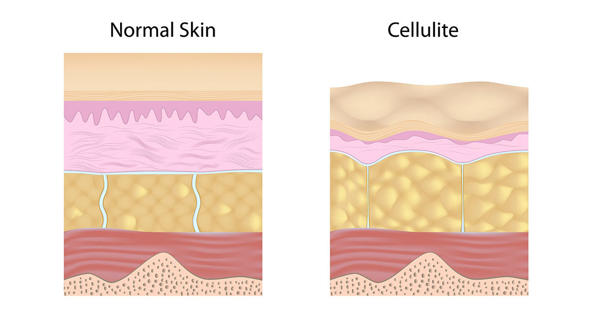 5 Natural Remedies for Getting Rid of Cellulite