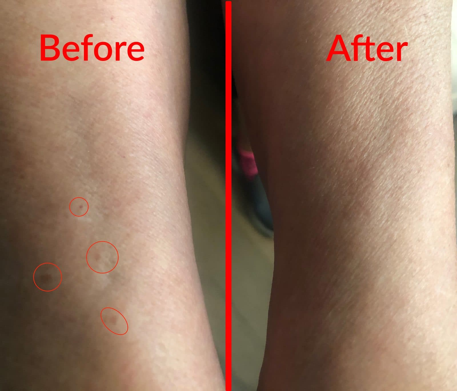 Before and after — dark spots on a forearm visibly faded