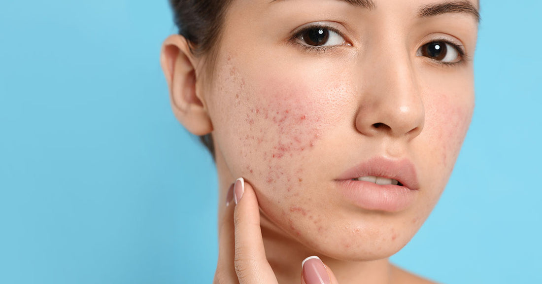 Does Glycolic Acid Help Heal Acne Scars?