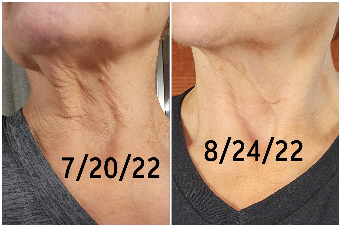 Before and after photo of crepey skin on the neck, dated by the customer