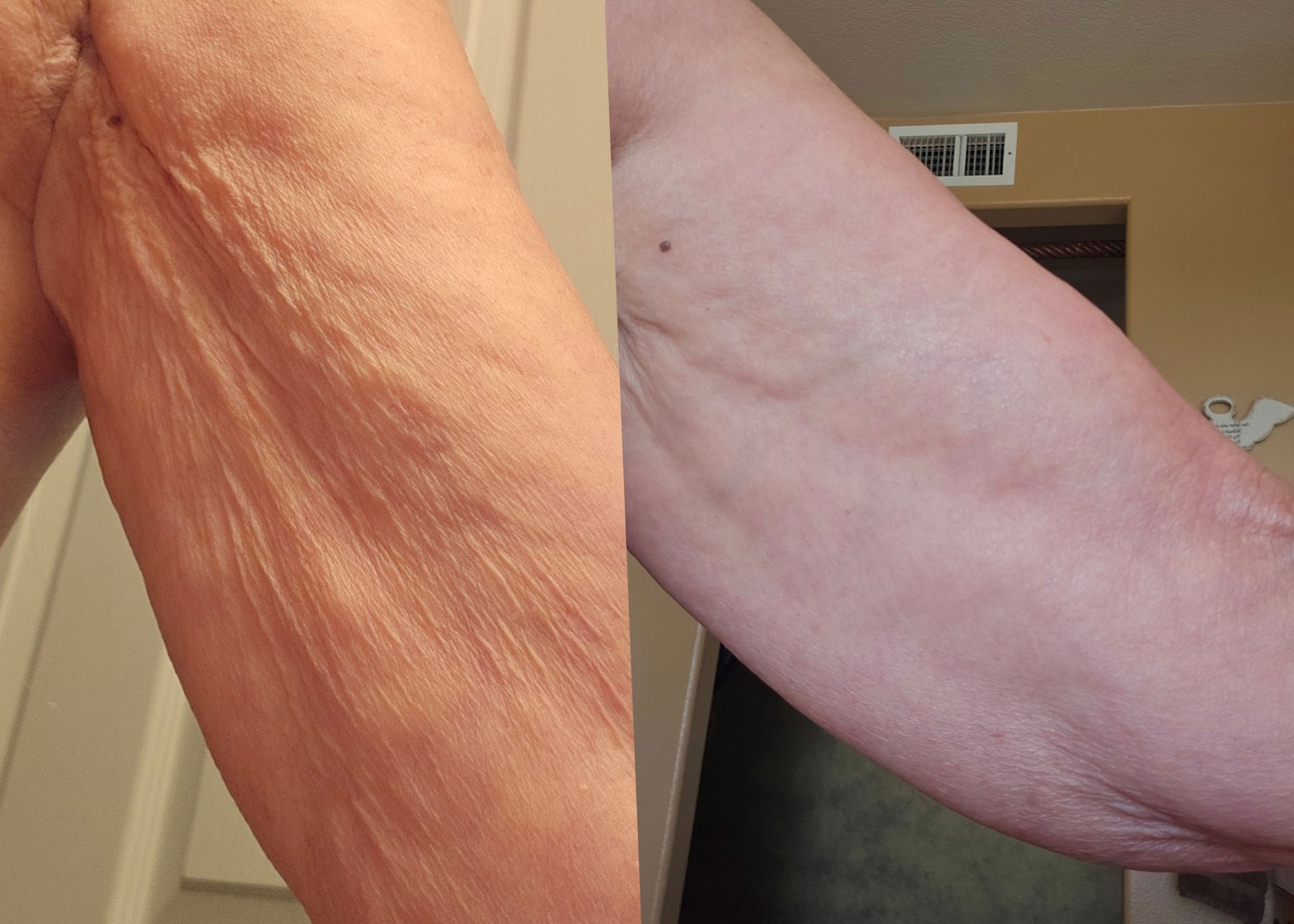 Before and after photo of crepey skin on the upper arm, sent in by a customer